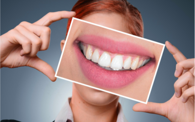 Parodontitis – wenn das Zahnfleisch verschwindet!